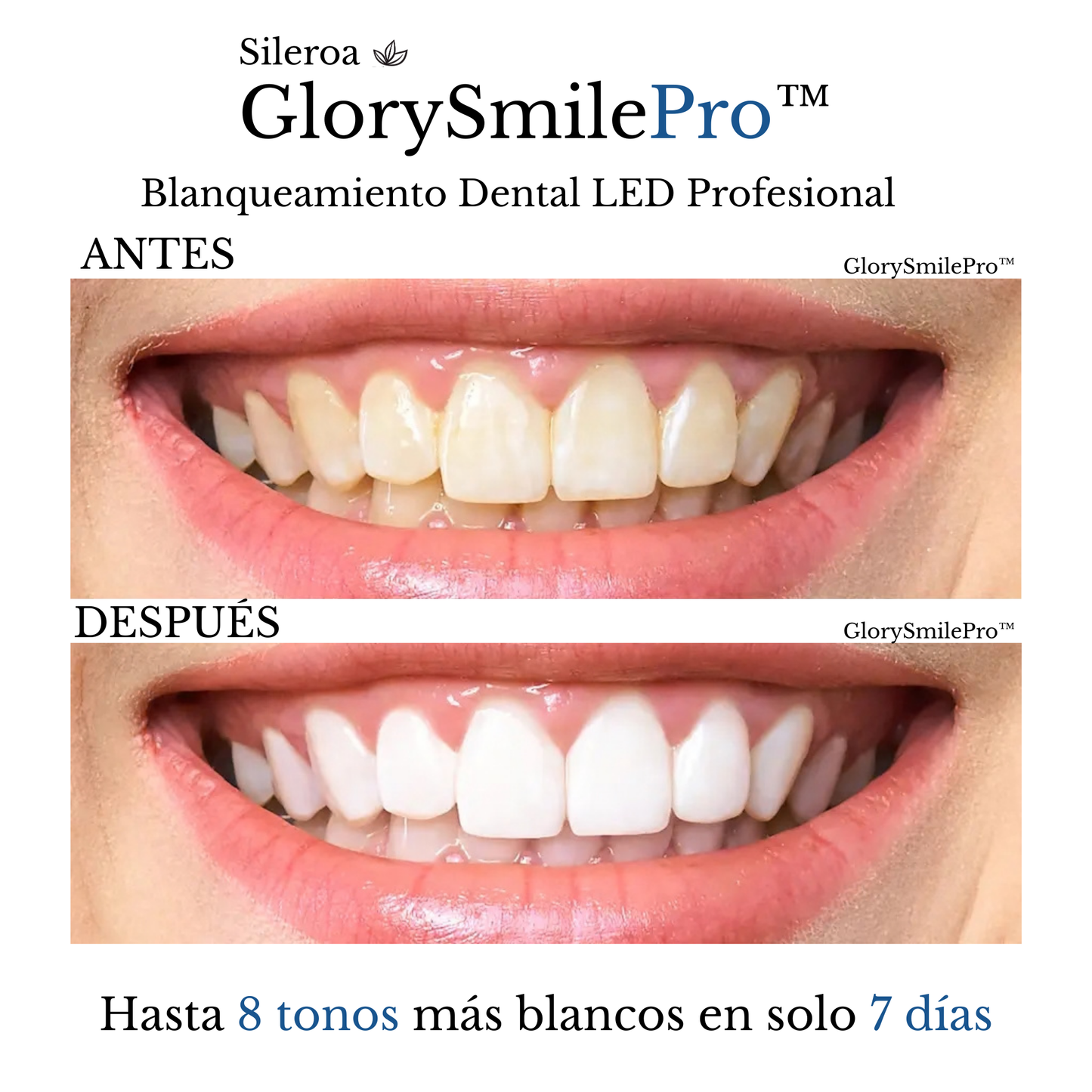 GlorySmilePro™ | Kit de Blanqueamiento Dental LED Profesional
