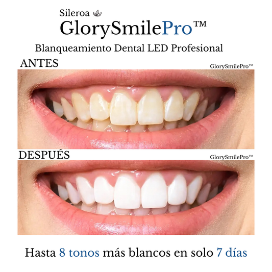 GlorySmilePro™ | Kit de Blanqueamiento Dental LED Profesional